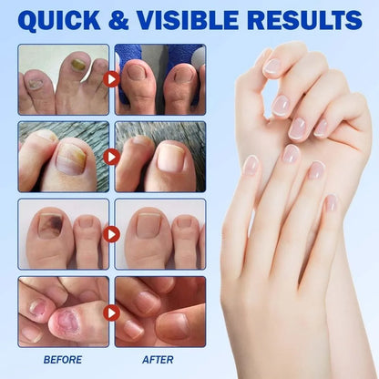 NAILFIX REPAIR PATCHES